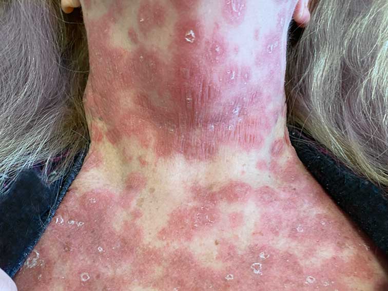 Rash