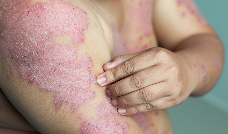 Psoriasis