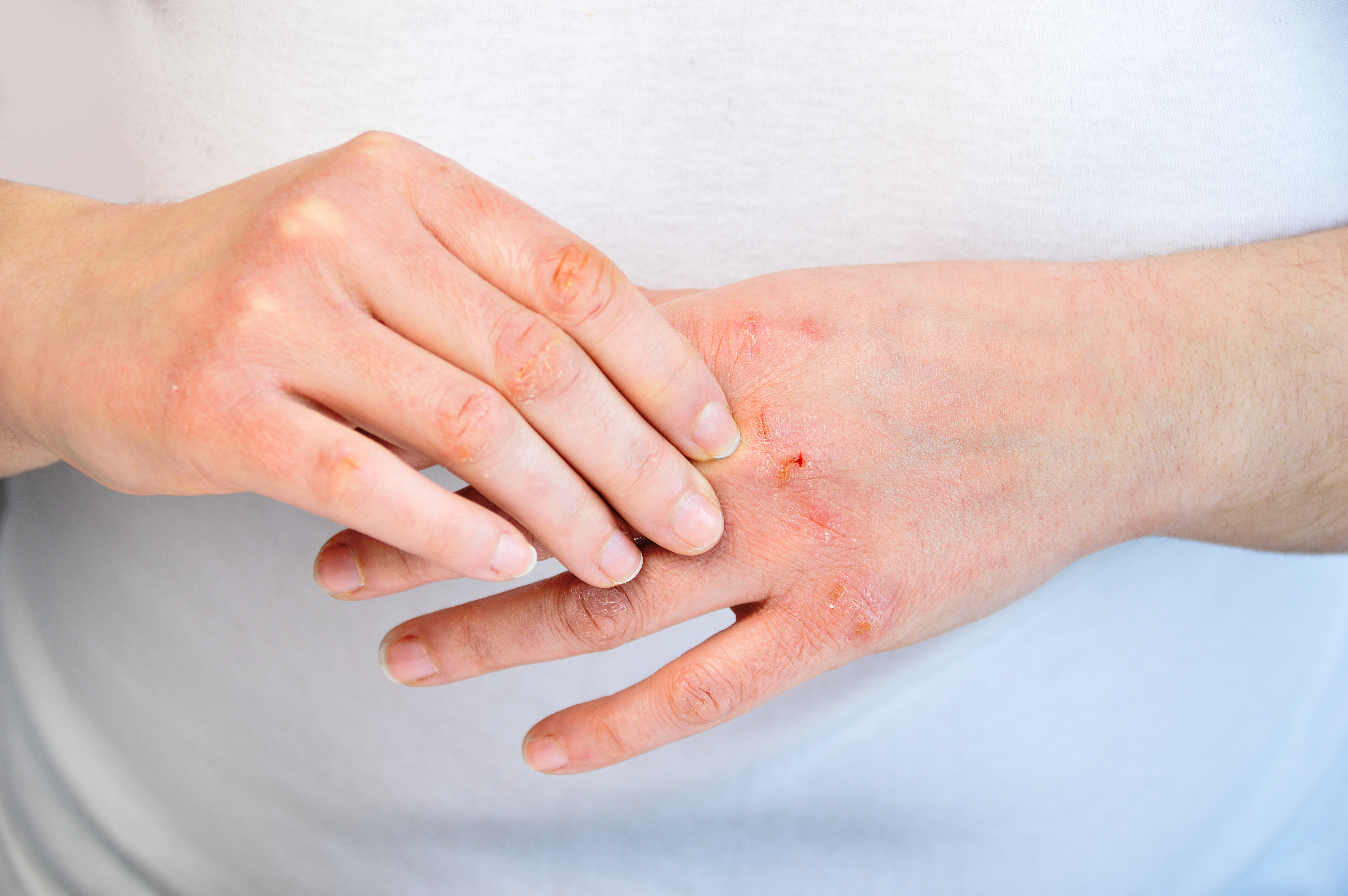 Dermatitis